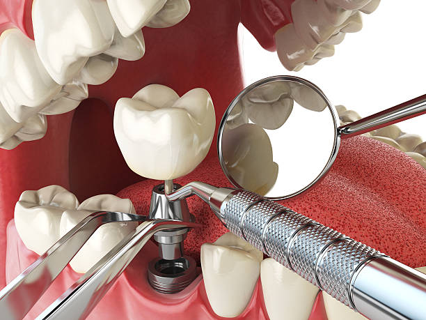 Best Emergency Dental Care for Broken or Chipped Teeth in Winter Park, FL